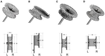 Unplanned Surgery After Transcatheter Closure of Ventricular Septal Defect in Children: Causes and Risk Factors